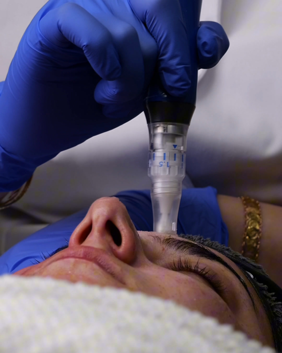 The microneedling pen being moved across a client's forehead