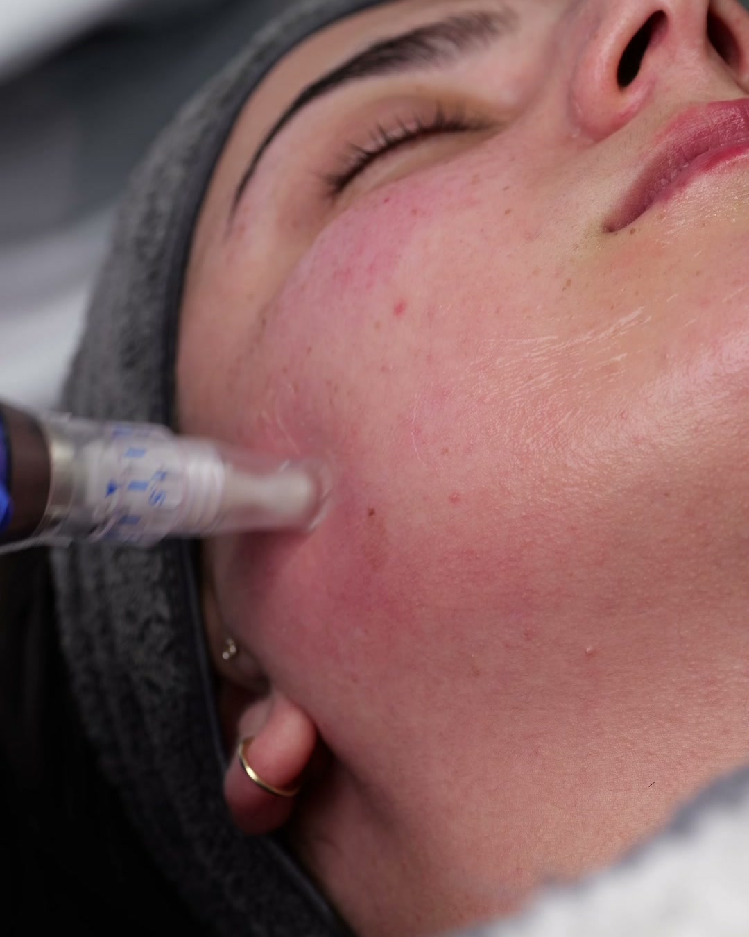 Close-up of the microneedling pen working across a client's cheek